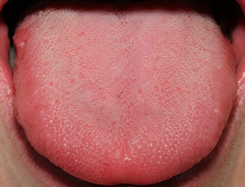 ¿Por qué salen granos en la lengua? Causas y tratamiento
