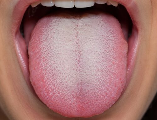 ¿Por qué tengo la lengua blanca y cómo puedo limpiarla?