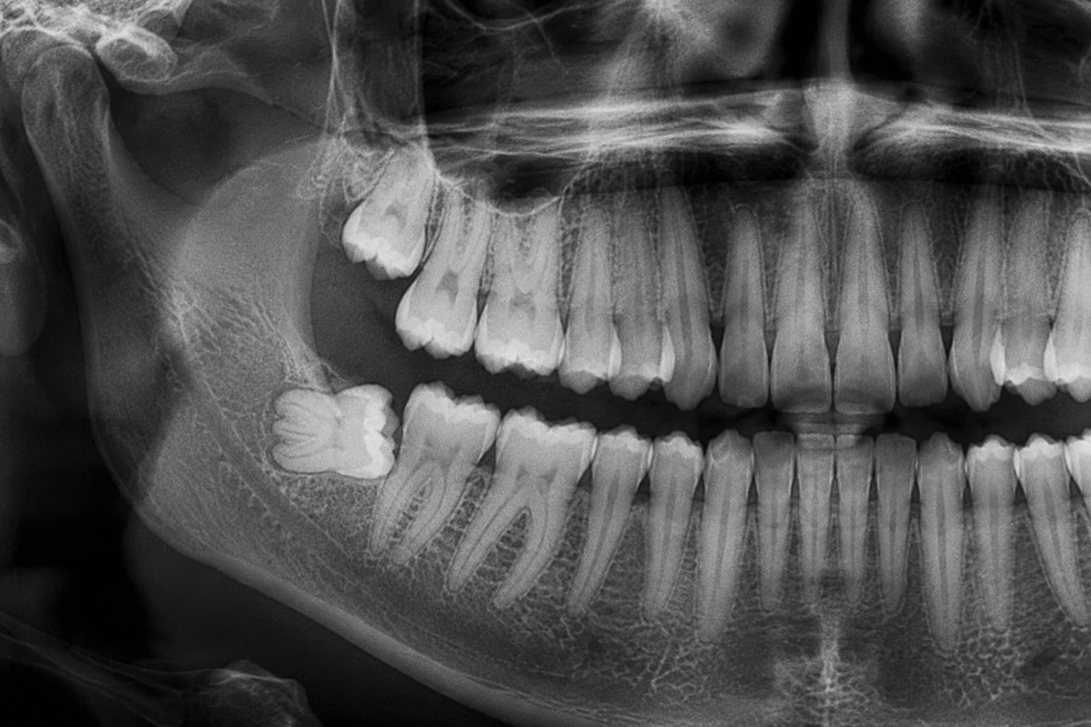 muela de juicio