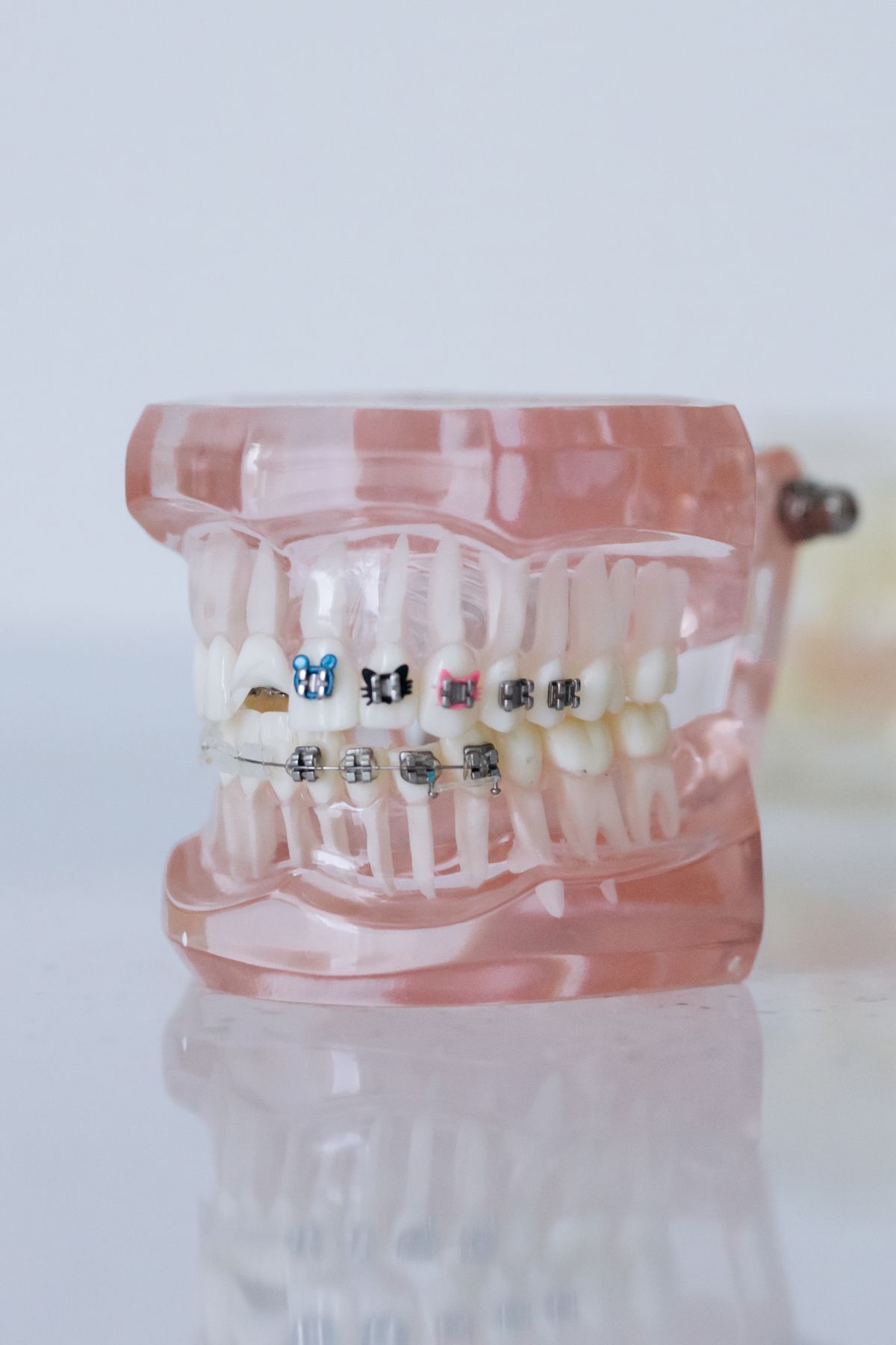 Modelo dental con brackets metálicos