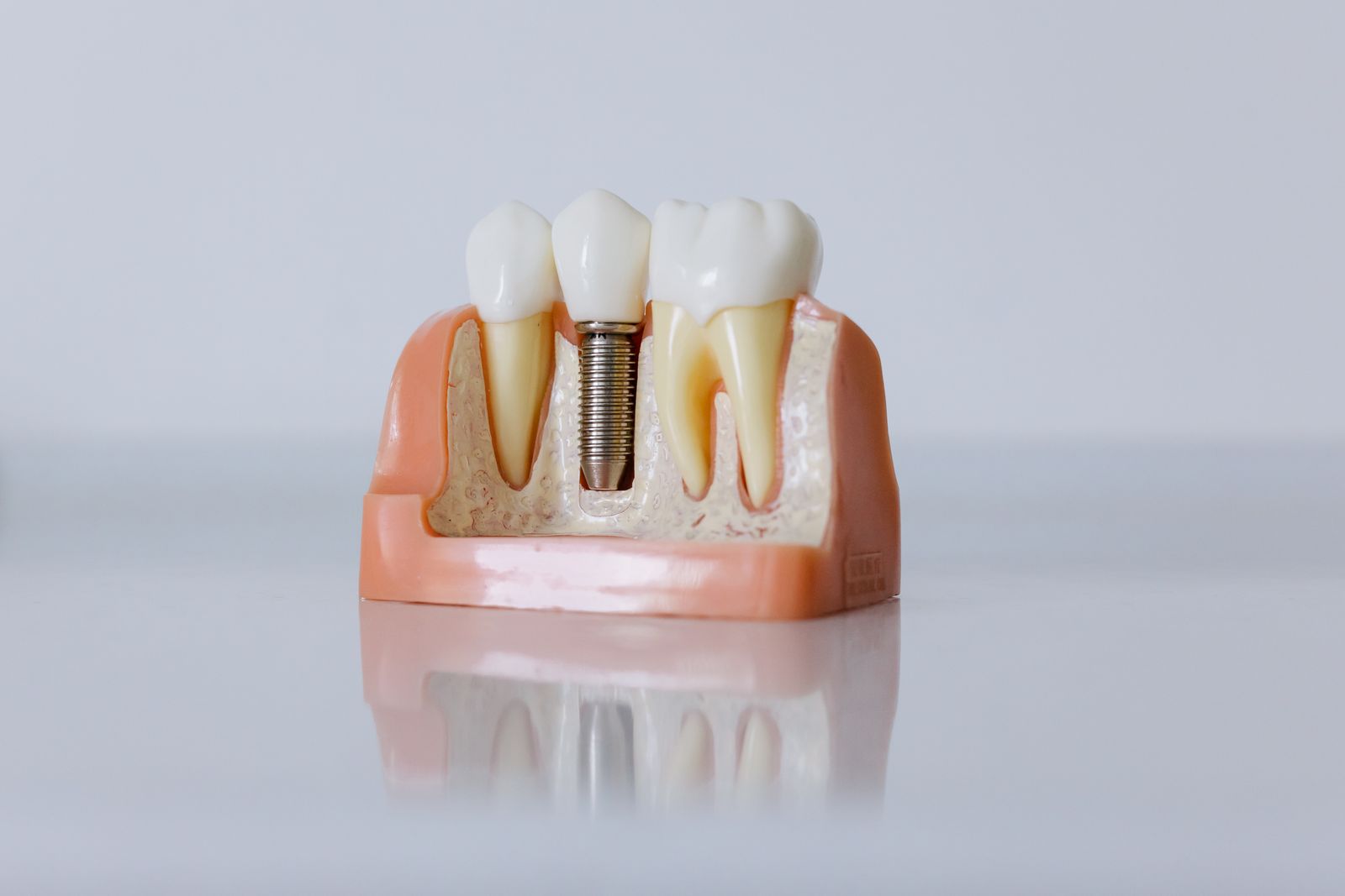 Modelo de implantes dentales con coronas